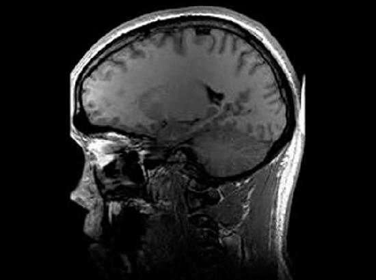 Study links increase in delirium, rare brain inflammation and stroke to COVID-19