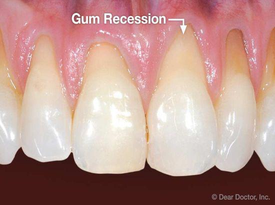 Gums recession? Have some tips on causes and treatment
