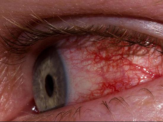 US woman first to be infected with 14 eye worms