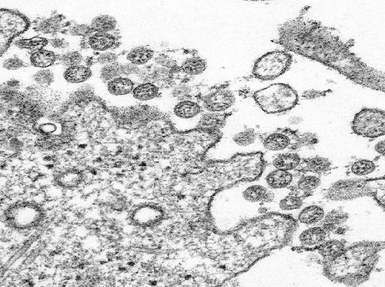 Coronavirus attaches to receptor on respiratory cells, hijack them to produce multiple copies: Study