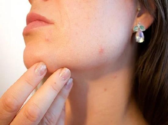 Some COVID patients face skin problems even after recovery, finds study